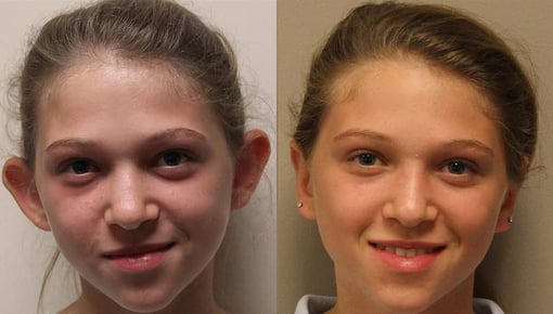 otoplasty before and after photos by kryger institute of plastic surgery in thousand oaks ca