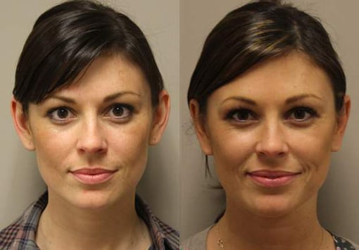 otoplasty before and after photos by kryger institute of plastic surgery in thousand oaks ca