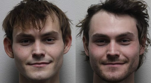 otoplasty before and after photos by kryger institute of plastic surgery in thousand oaks ca