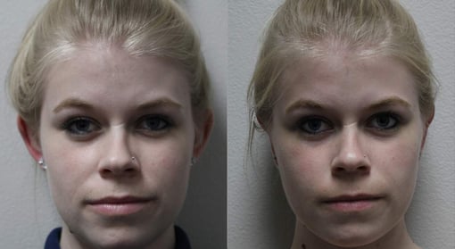 otoplasty before and after photos by kryger institute of plastic surgery in thousand oaks ca