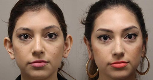 otoplasty before and after photos by kryger institute of plastic surgery in thousand oaks ca