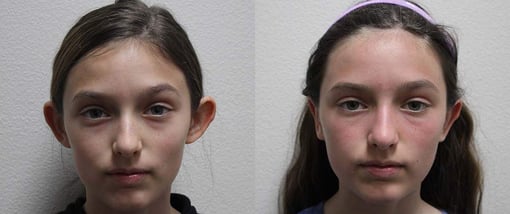 otoplasty before and after photos by kryger institute of plastic surgery in thousand oaks ca
