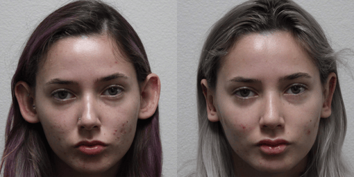 otoplasty before and after photos by kryger institute of plastic surgery in thousand oaks ca
