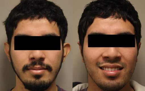 otoplasty before and after photos by kryger institute of plastic surgery in thousand oaks ca