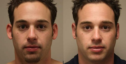 otoplasty before and after photos by kryger institute of plastic surgery in thousand oaks ca