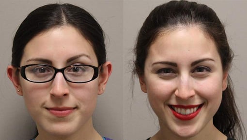 otoplasty before and after photos by kryger institute of plastic surgery in thousand oaks ca