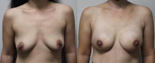 nipple sparing mastectomy reconstruction before and after photos by kryger institute of plastic surgery in thousand oaks ca