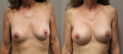 nipple sparing mastectomy reconstruction before and after photos by kryger institute of plastic surgery in thousand oaks ca