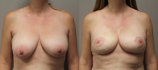 nipple sparing mastectomy reconstruction before and after photos by kryger institute of plastic surgery in thousand oaks ca