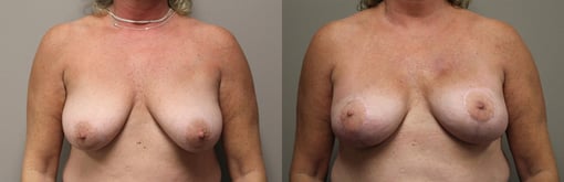 nipple sparing mastectomy reconstruction before and after photos by kryger institute of plastic surgery in thousand oaks ca