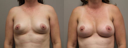 nipple sparing mastectomy reconstruction before and after photos by kryger institute of plastic surgery in thousand oaks ca