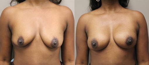 nipple sparing mastectomy reconstruction before and after photos by kryger institute of plastic surgery in thousand oaks ca