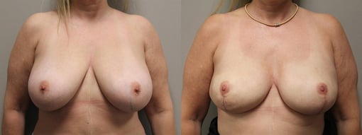 nipple sparing mastectomy reconstruction before and after photos by kryger institute of plastic surgery in thousand oaks ca