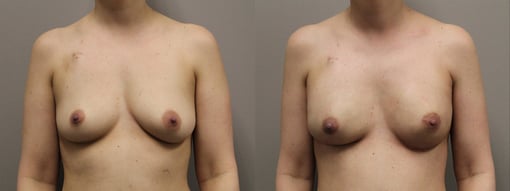 nipple sparing mastectomy reconstruction before and after photos by kryger institute of plastic surgery in thousand oaks ca
