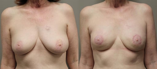 nipple sparing mastectomy reconstruction before and after photos by kryger institute of plastic surgery in thousand oaks ca