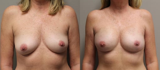 nipple sparing mastectomy reconstruction before and after photos by kryger institute of plastic surgery in thousand oaks ca