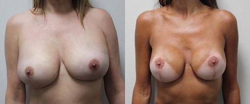 nipple sparing mastectomy reconstruction before and after photos by kryger institute of plastic surgery in thousand oaks ca