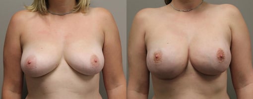nipple sparing mastectomy reconstruction before and after photos by kryger institute of plastic surgery in thousand oaks ca