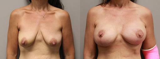 nipple sparing mastectomy reconstruction before and after photos by kryger institute of plastic surgery in thousand oaks ca