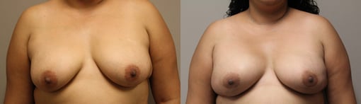 nipple sparing mastectomy reconstruction before and after photos by kryger institute of plastic surgery in thousand oaks ca