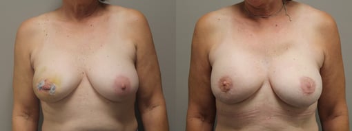 nipple sparing mastectomy reconstruction before and after photos by kryger institute of plastic surgery in thousand oaks ca