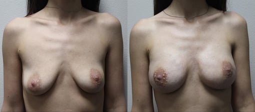 nipple sparing mastectomy reconstruction before and after photos by kryger institute of plastic surgery in thousand oaks ca