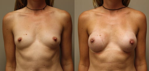 nipple sparing mastectomy reconstruction before and after photos by kryger institute of plastic surgery in thousand oaks ca