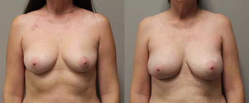 nipple sparing mastectomy reconstruction before and after photos by kryger institute of plastic surgery in thousand oaks ca
