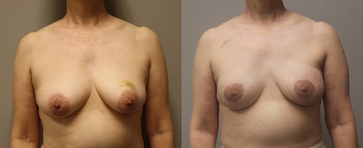 nipple sparing mastectomy reconstruction before and after photos by kryger institute of plastic surgery in thousand oaks ca