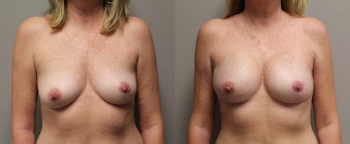 nipple sparing mastectomy reconstruction before and after photos by kryger institute of plastic surgery in thousand oaks ca