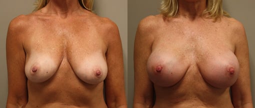 nipple sparing mastectomy reconstruction before and after photos by kryger institute of plastic surgery in thousand oaks ca