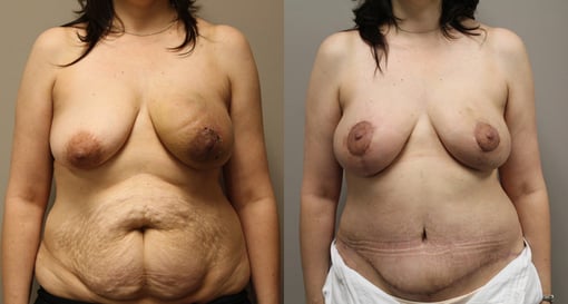 nipple sparing mastectomy reconstruction before and after photos by kryger institute of plastic surgery in thousand oaks ca