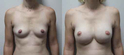 nipple sparing mastectomy reconstruction before and after photos by kryger institute of plastic surgery in thousand oaks ca
