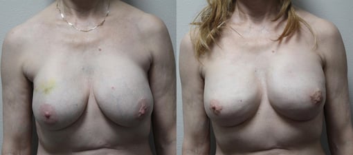 nipple sparing mastectomy reconstruction before and after photos by kryger institute of plastic surgery in thousand oaks ca