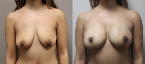 nipple sparing mastectomy reconstruction before and after photos by kryger institute of plastic surgery in thousand oaks ca