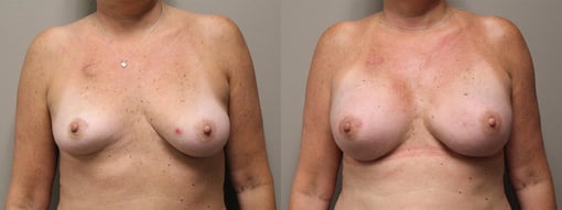 nipple sparing mastectomy reconstruction before and after photos by kryger institute of plastic surgery in thousand oaks ca