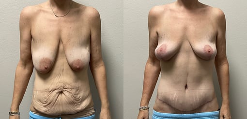 mommy makeover before and after photos by kryger institute of plastic surgery in thousand oaks ca