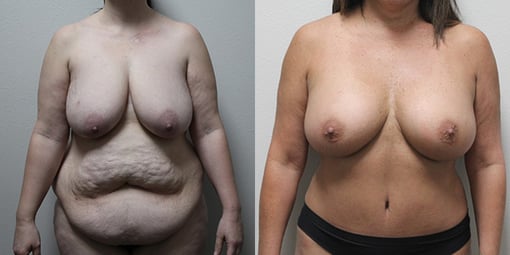 mommy makeover before and after photos by kryger institute of plastic surgery in thousand oaks ca