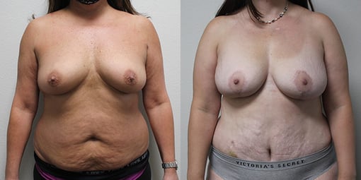 mommy makeover before and after photos by kryger institute of plastic surgery in thousand oaks ca