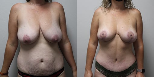 mommy makeover before and after photos by kryger institute of plastic surgery in thousand oaks ca