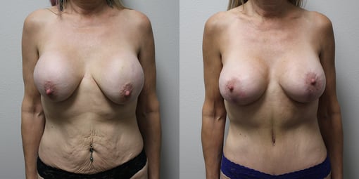 mommy makeover before and after photos by kryger institute of plastic surgery in thousand oaks ca