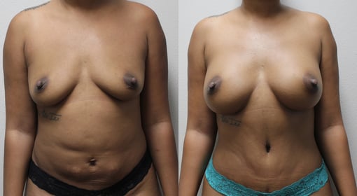mommy makeover before and after photos by kryger institute of plastic surgery in thousand oaks ca