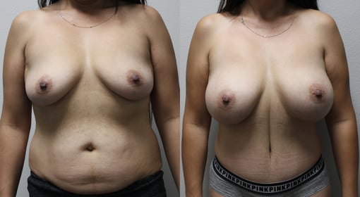 mommy makeover before and after photos by kryger institute of plastic surgery in thousand oaks ca