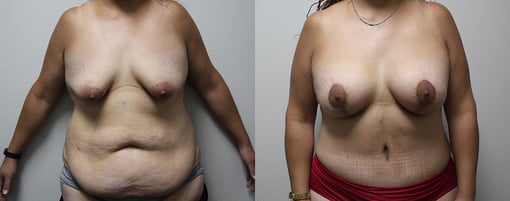 mommy makeover before and after photos by kryger institute of plastic surgery in thousand oaks ca