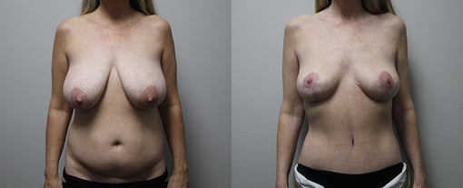 mommy makeover before and after photos by kryger institute of plastic surgery in thousand oaks ca