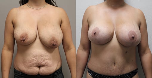 mommy makeover before and after photos by kryger institute of plastic surgery in thousand oaks ca