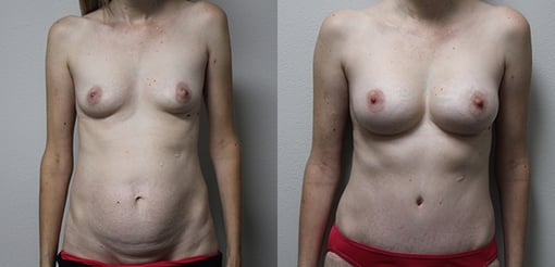 mommy makeover before and after photos by kryger institute of plastic surgery in thousand oaks ca