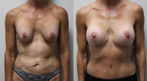 mommy makeover before and after photos by kryger institute of plastic surgery in thousand oaks ca