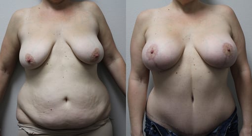 mommy makeover before and after photos by kryger institute of plastic surgery in thousand oaks ca