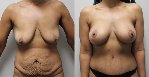 mommy makeover before and after photos by kryger institute of plastic surgery in thousand oaks ca